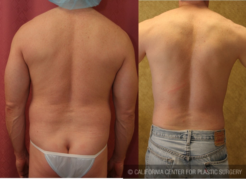 Male Liposuction Abdomen Before & After Patient #5670