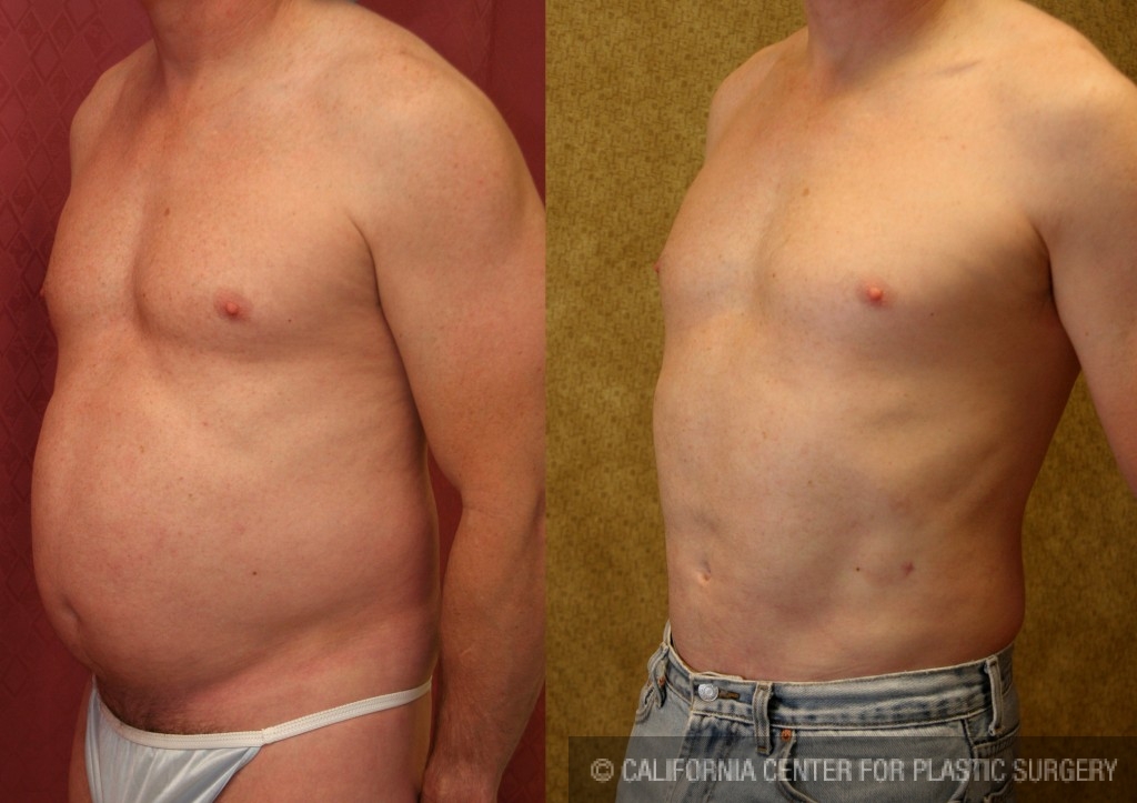 Male Liposuction Abdomen Before & After Patient #5670