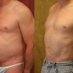 Male Liposuction Abdomen Before & After Patient #5670