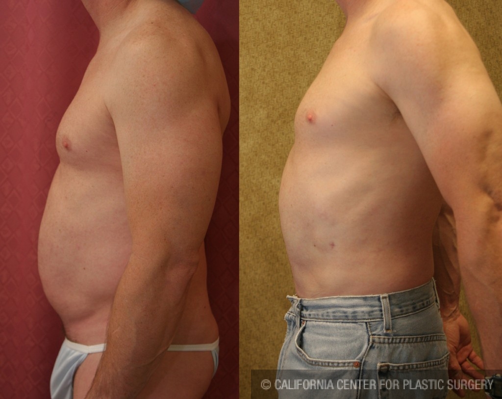 Male Liposuction Abdomen Before & After Patient #5670