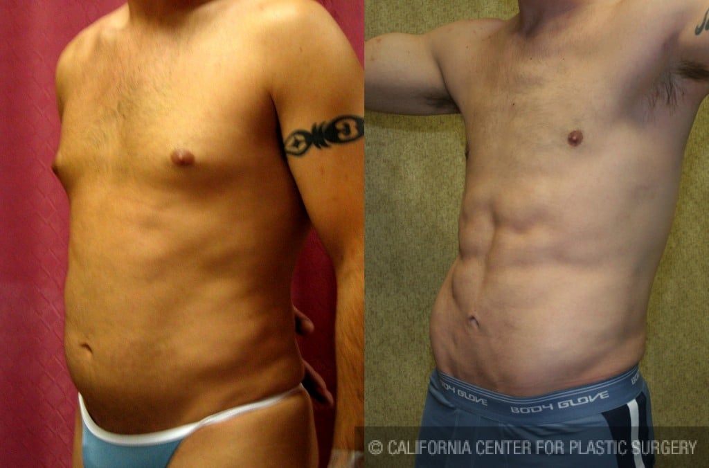 Male Liposuction Abdomen Before & After Patient #5604