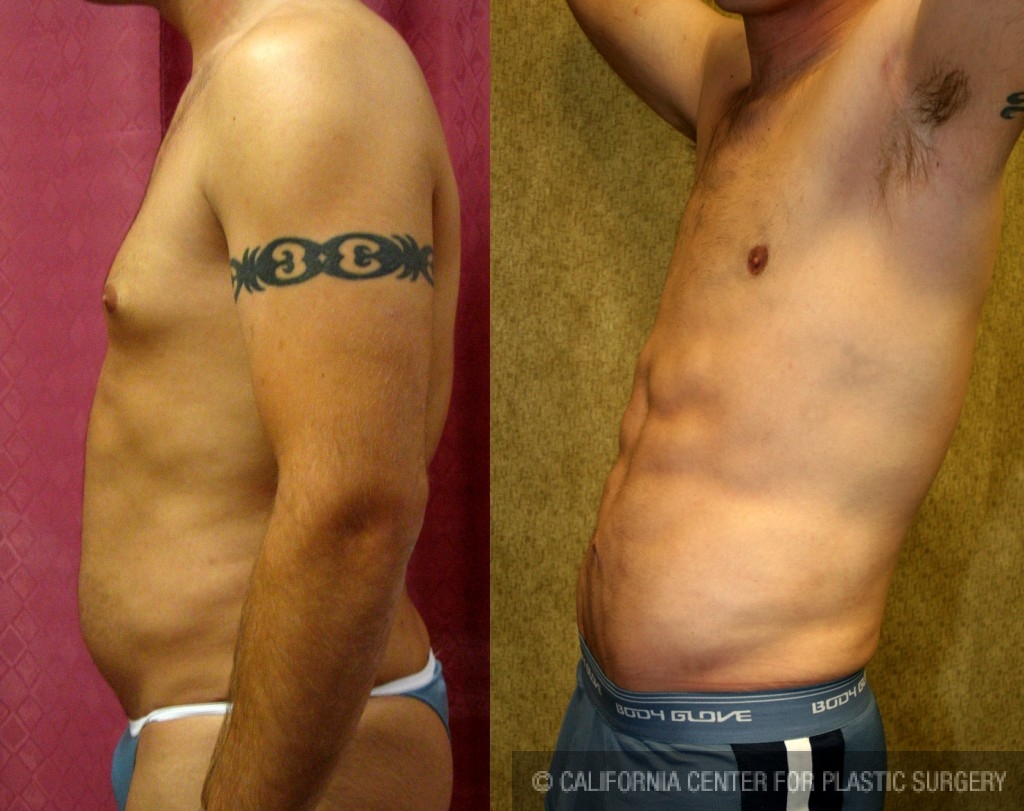 Male Liposuction Abdomen Before & After Patient #5604