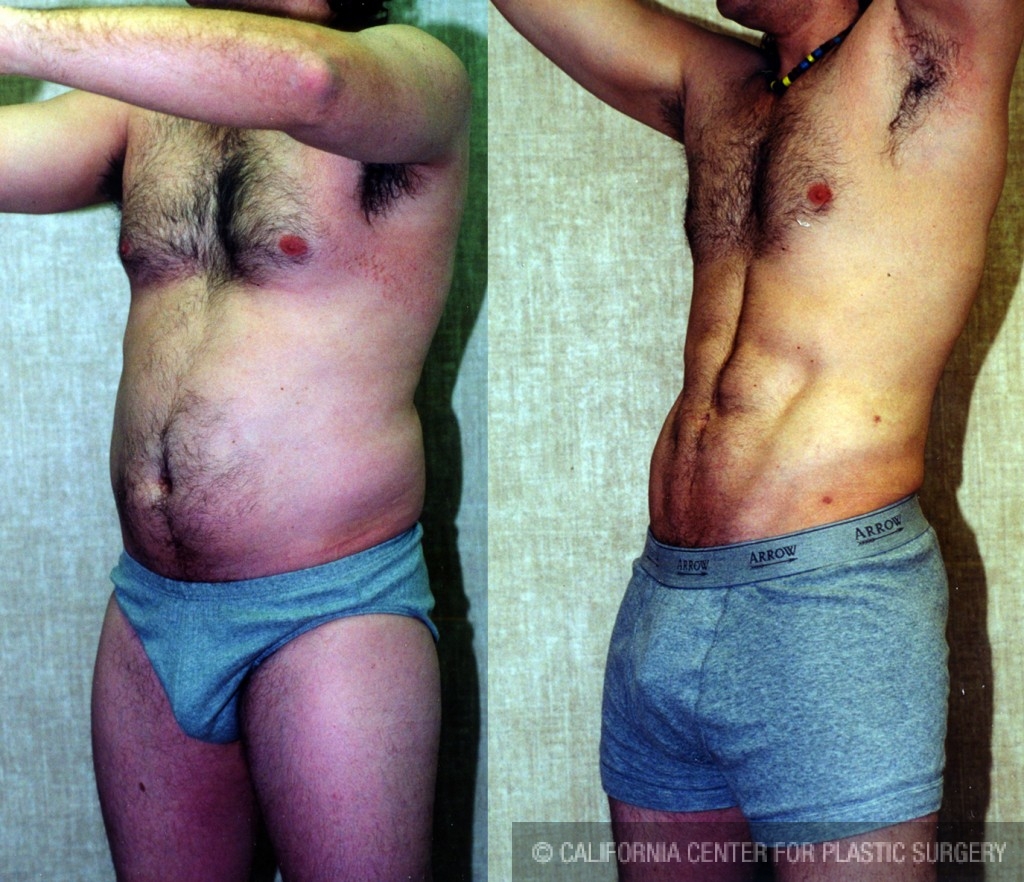 Male Liposuction Abdomen Before & After Patient #5609