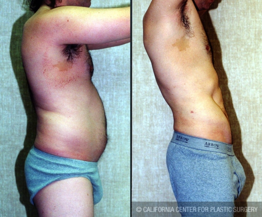 Male Liposuction Abdomen Before & After Patient #5609