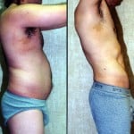 Male Liposuction Abdomen Before & After Patient #5609