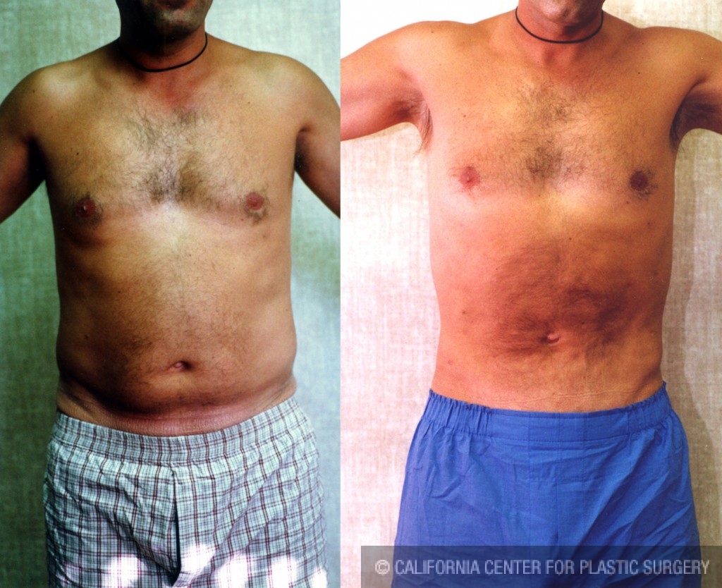 Male Liposuction Abdomen Before & After Patient #5625