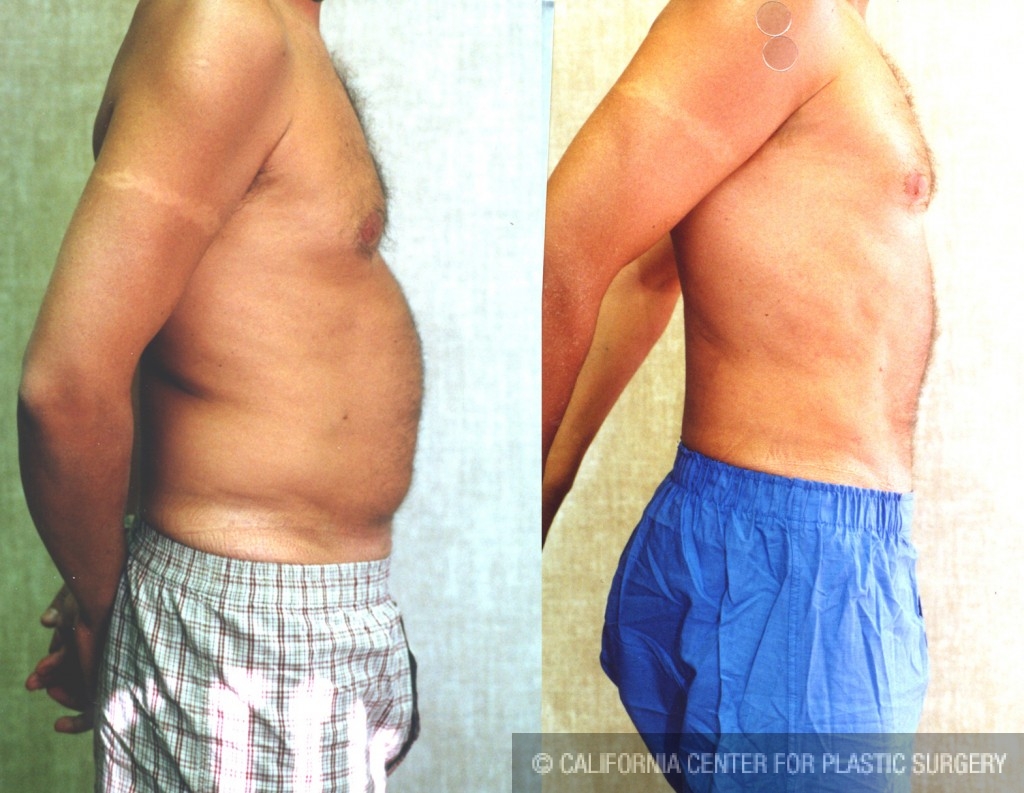 Male Liposuction Abdomen Before & After Patient #5625