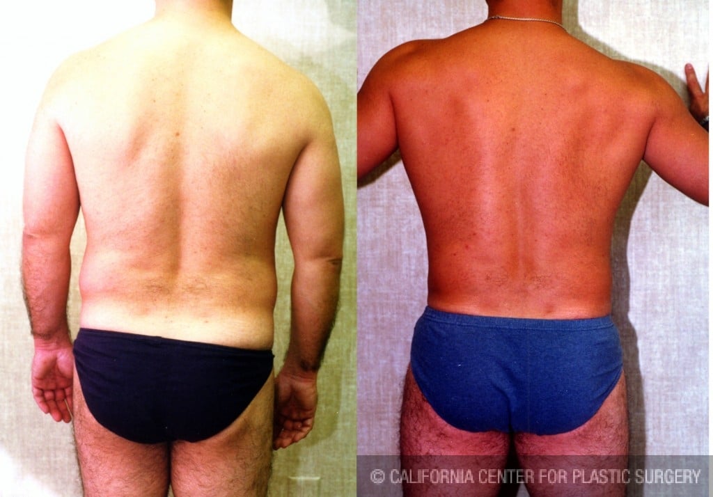 Male Liposuction Abdomen Before & After Patient #5633