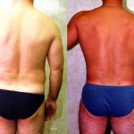 Male Liposuction Abdomen Before & After Patient #5633