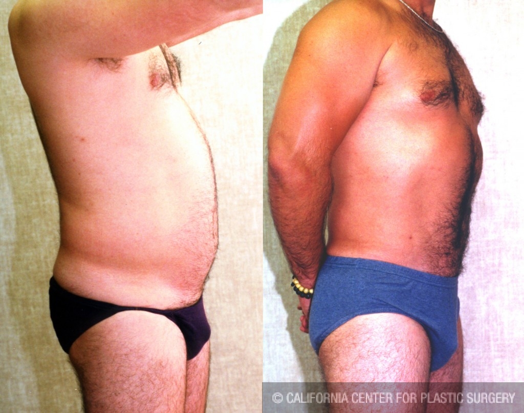 Male Liposuction Abdomen Before & After Patient #5633