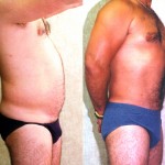 Male Liposuction Abdomen Before & After Patient #5633