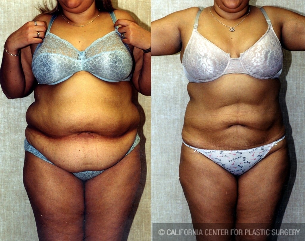 Liposuction Abdomen Plus Size Before & After Patient #5575