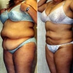 Liposuction Abdomen Plus Size Before & After Patient #5575
