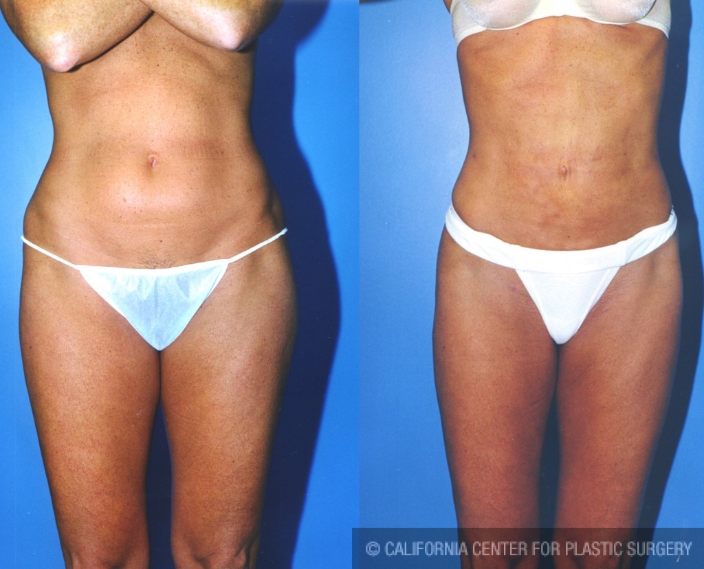 Liposuction Abdomen Medium Before & After Patient #5548