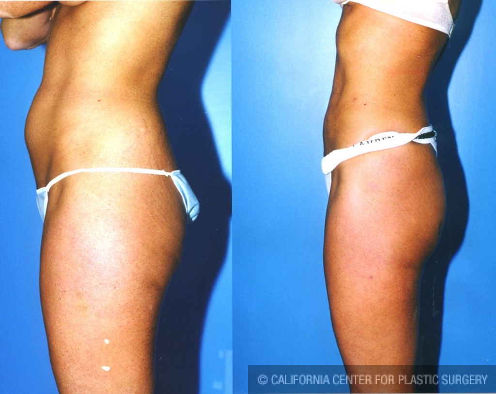 Liposuction Abdomen Medium Before & After Patient #5548