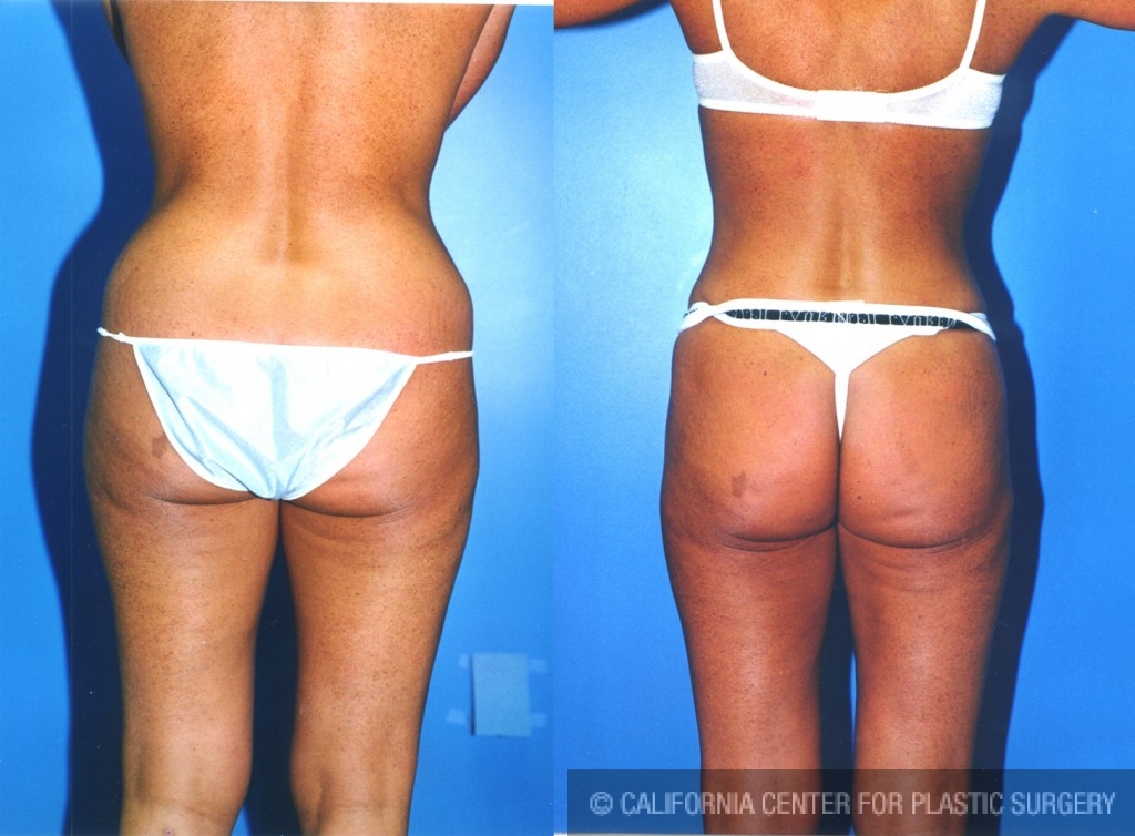 Liposuction Abdomen Medium Before & After Patient #5548