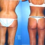 Liposuction Abdomen Medium Before & After Patient #5548