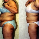 Liposuction Abdomen Plus Size Before & After Patient #5575