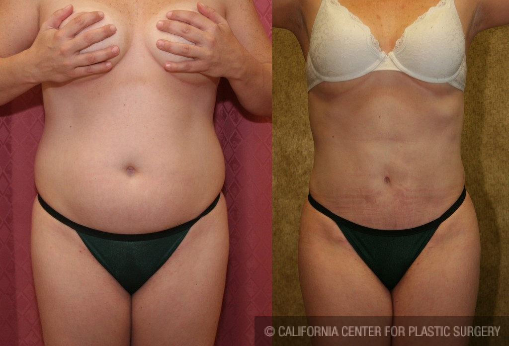 Liposuction Abdomen Medium Before & After Patient #5566