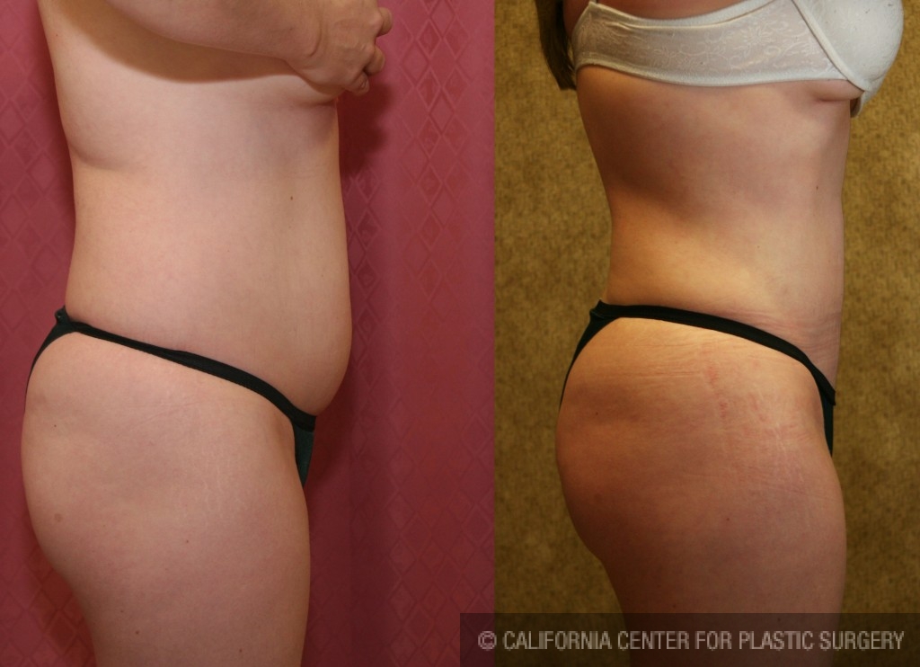 Liposuction Abdomen Medium Before & After Patient #5566