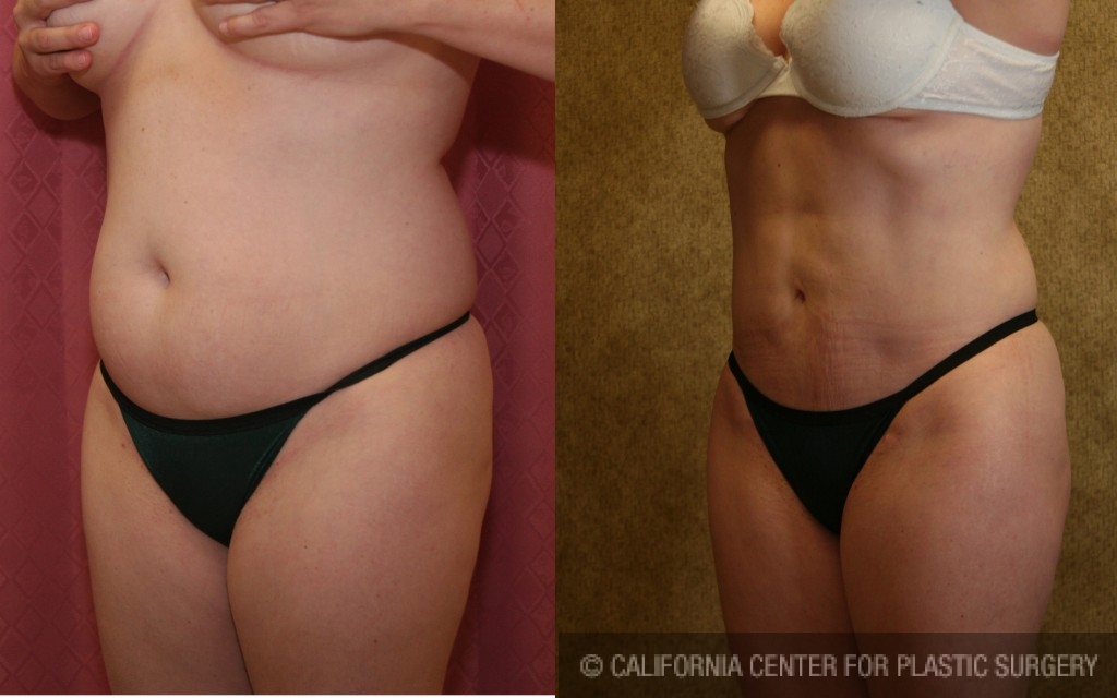 Liposuction Abdomen Medium Before & After Patient #5566