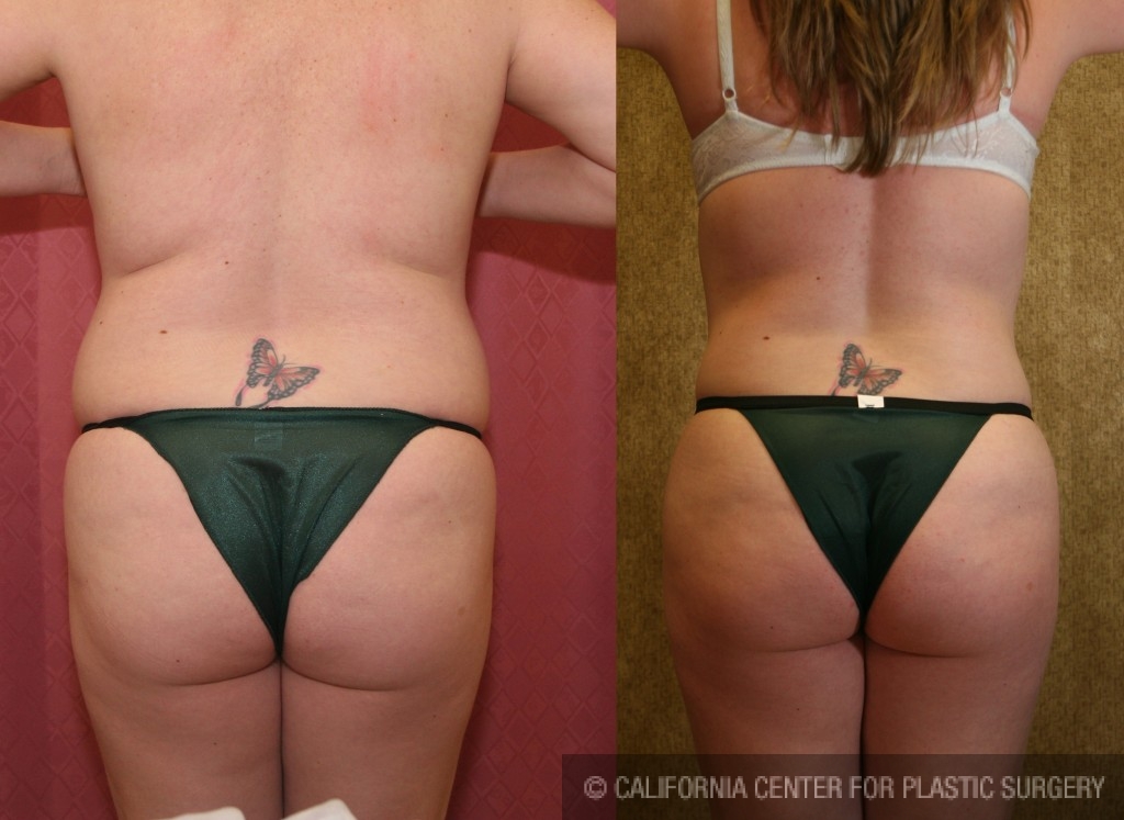 Liposuction Abdomen Medium Before & After Patient #5566