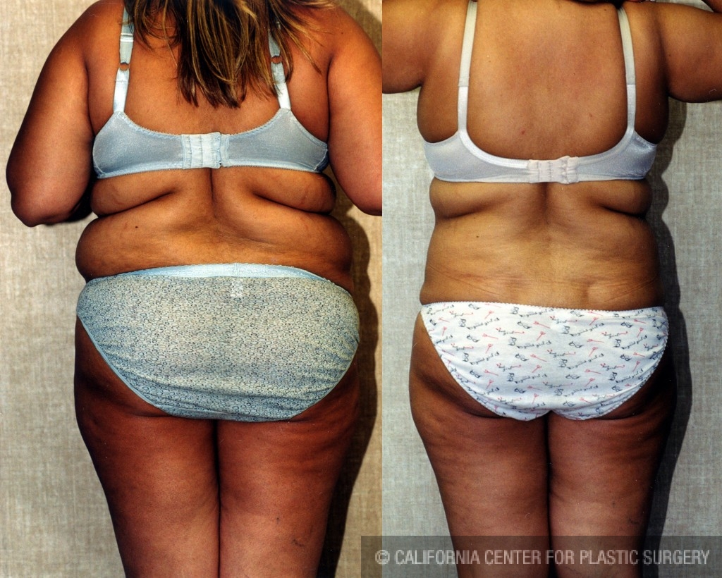 Liposuction Abdomen Plus Size Before & After Patient #5575