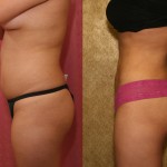 Liposuction Abdomen Medium Before & After Patient #5514
