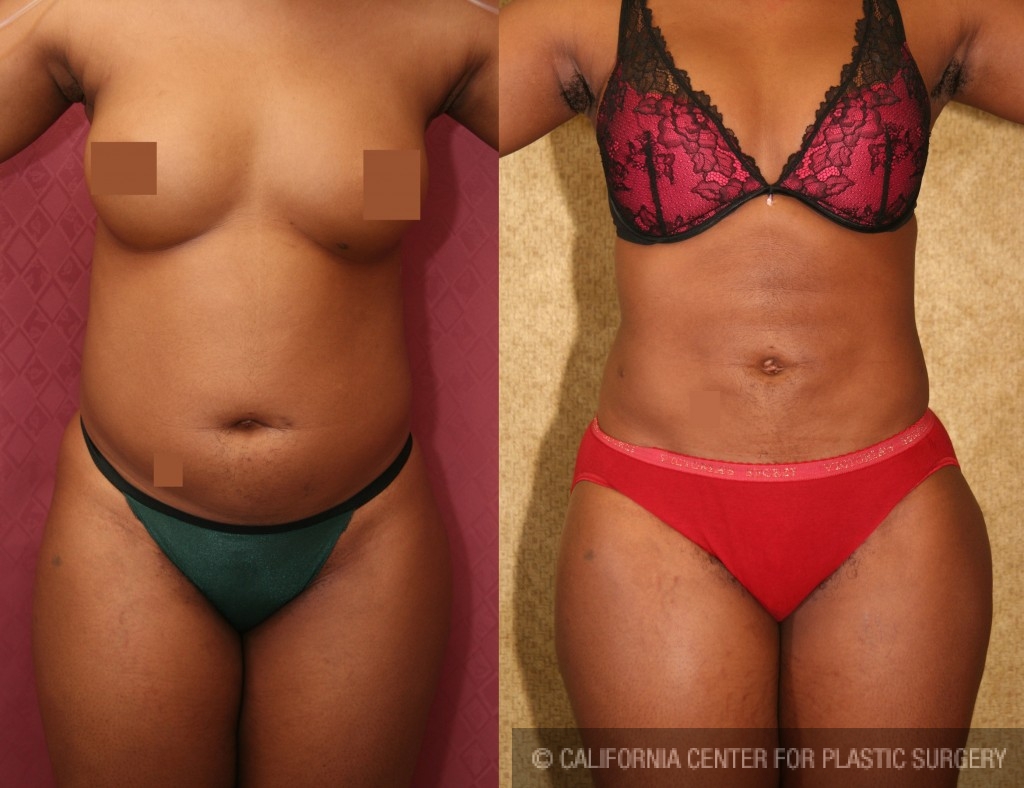 Liposuction Abdomen Medium Before & After Patient #5557