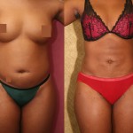 Liposuction Abdomen Medium Before & After Patient #5557