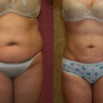 Liposuction Abdomen Plus Size Before & After Patient #5589