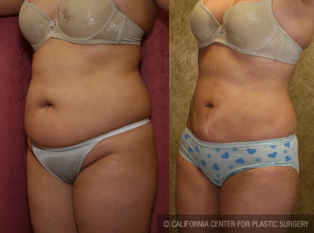 Liposuction Abdomen Plus Size Before & After Patient #5589