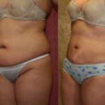 Liposuction Abdomen Plus Size Before & After Patient #5589