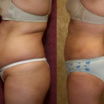 Liposuction Abdomen Plus Size Before & After Patient #5589