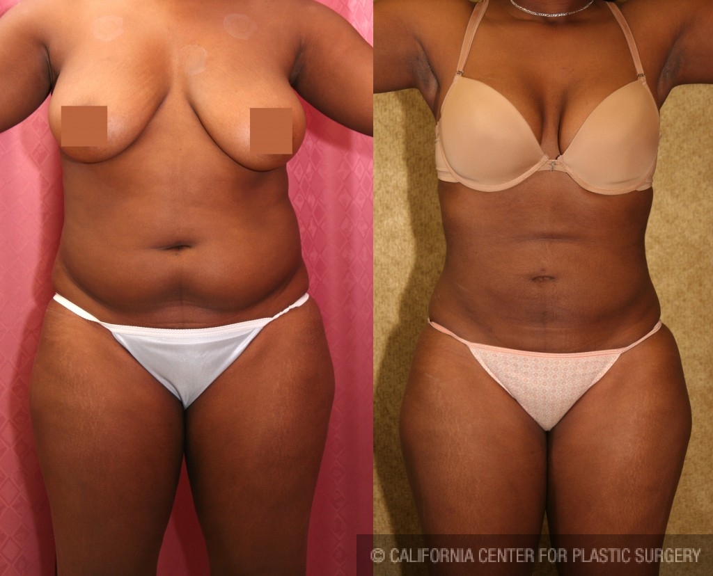 Liposuction Abdomen Medium Before & After Patient #5561