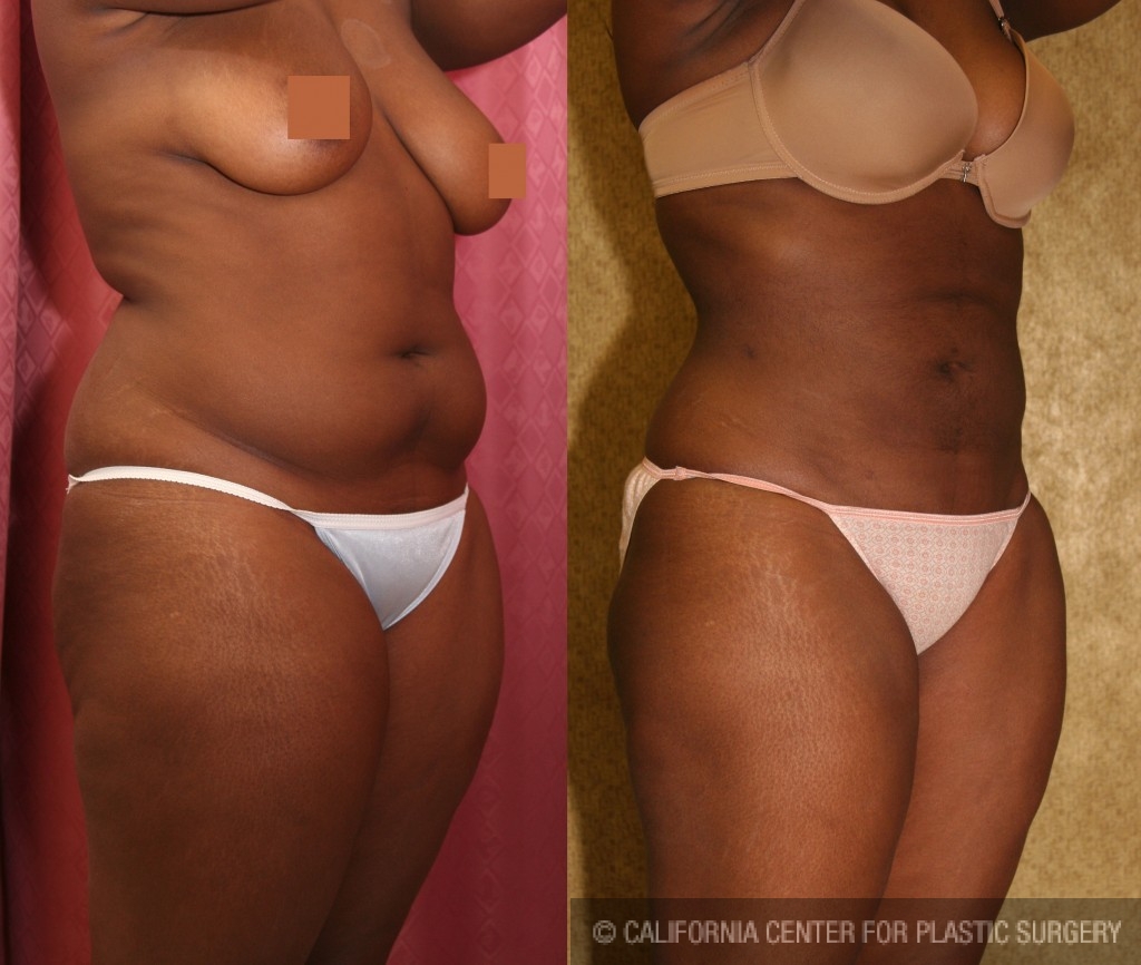 Liposuction Abdomen Medium Before & After Patient #5561