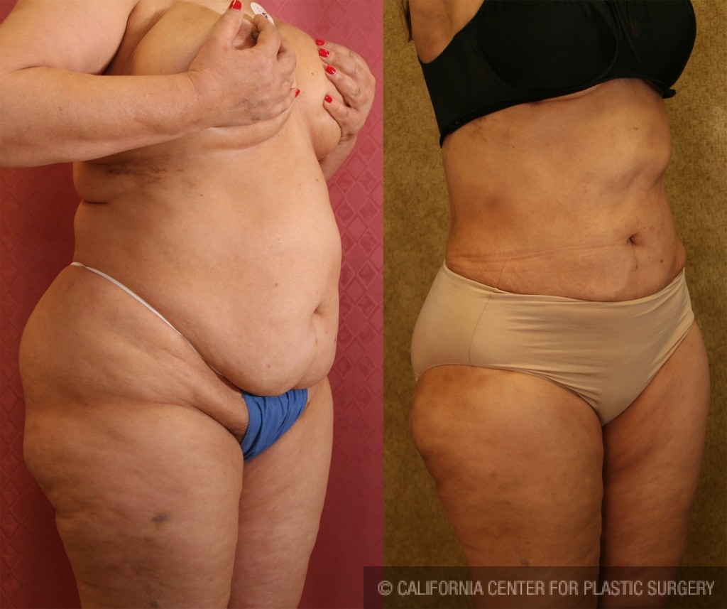 Liposuction Abdomen Plus Size Before & After Patient #5593