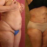 Liposuction Abdomen Plus Size Before & After Patient #5593