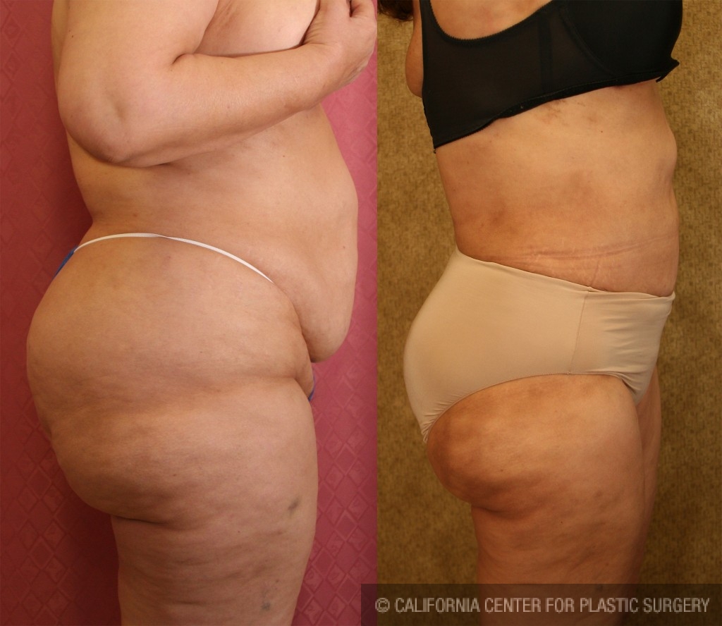 Liposuction Abdomen Plus Size Before & After Patient #5593