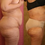 Liposuction Abdomen Plus Size Before & After Patient #5593