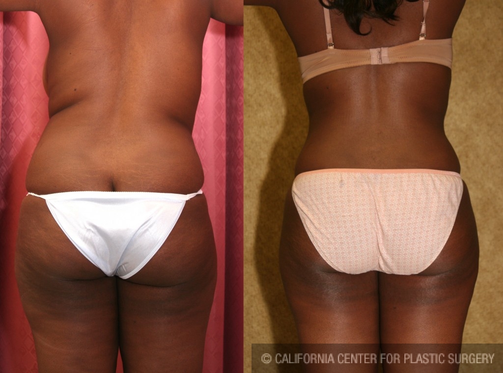 Liposuction Abdomen Medium Before & After Patient #5561