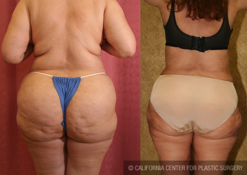 Liposuction Abdomen Plus Size Before & After Patient #5593