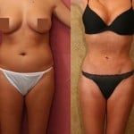 Liposuction Abdomen Medium Before & After Patient #5538