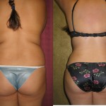 Liposuction Abdomen Medium Before & After Patient #5527
