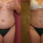 Liposuction Abdomen Medium Before & After Patient #5532