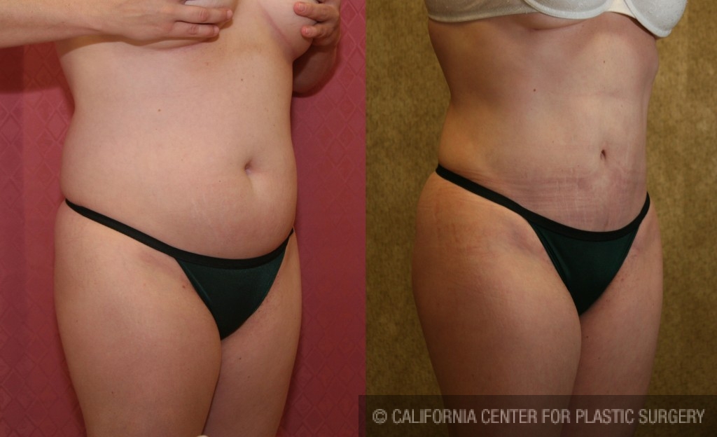 Liposuction Abdomen Medium Before & After Patient #5532