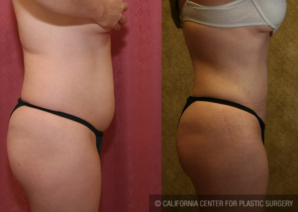 Liposuction Abdomen Medium Before & After Patient #5532