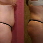 Liposuction Abdomen Medium Before & After Patient #5532