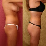 Liposuction Abdomen Medium Before & After Patient #5538