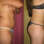 Liposuction Abdomen Medium Before & After Patient #5527